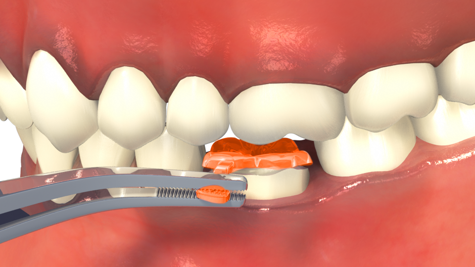 How to achieve correct occlusal distance when placing the One Visit